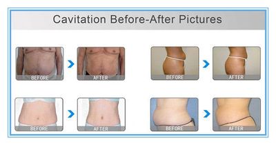 Ultrasonic Cavitation & Laser Lipo, Before and After photos