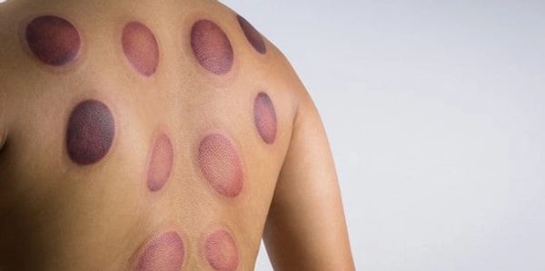 Cupping will leave marks