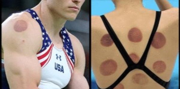 Cupping Therapy