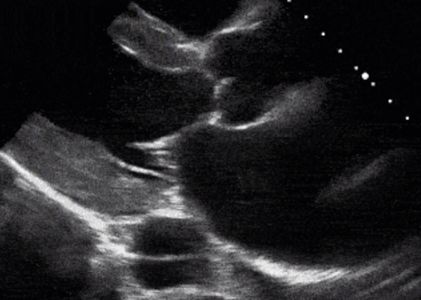 Echo aortic dissection, LAE and LVH