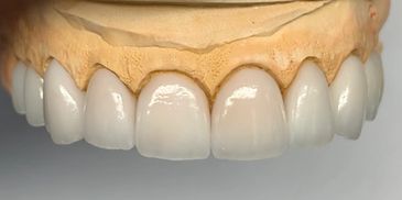 Emax pressed layered veneers 