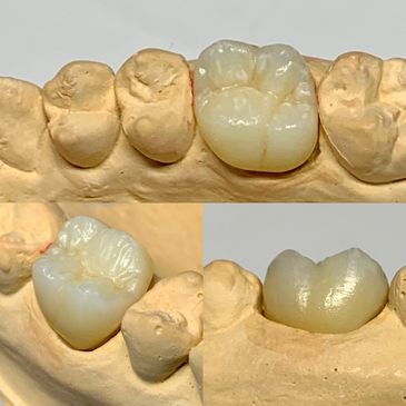 Emax layered single crown