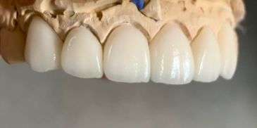 PFZ porcelain fused to zirconia 