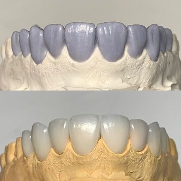 Diagnostic wax up design and Emax layered veneers for anterior smile design 