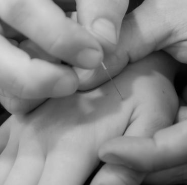 Close-up of acupuncture needle being inserted into a hand.