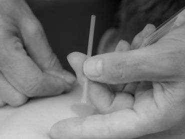 Close-up of hands performing acupuncture with a needle on skin.