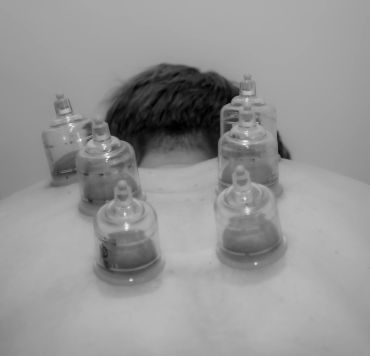 Person undergoing cupping therapy with multiple cups on their back.
