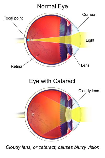 Two images showing normal eye versus eye with cataract and how light is dispersed and scattered.