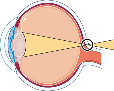 Image of eye shows how light focusses behind the eye instead of on the retina in hyperopia