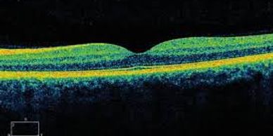 image shows OCT scan of a macula