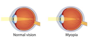 image shows a normal eye versus a short sighted myopic eye and how the light is not focussed, 