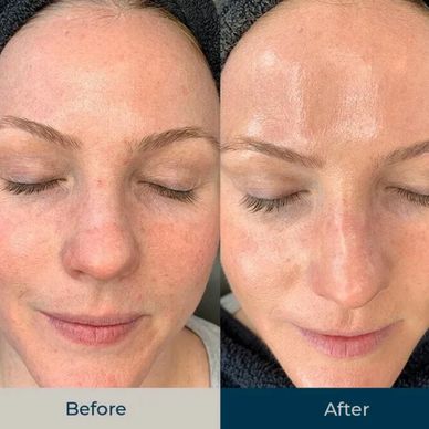 Hydrofacial treatment 