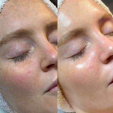 Hydrofacial treatment