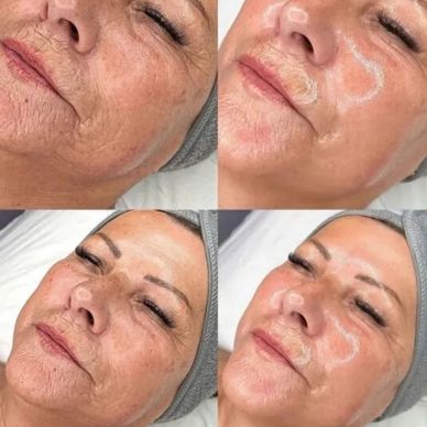 Anti aging hydrofacial treatment