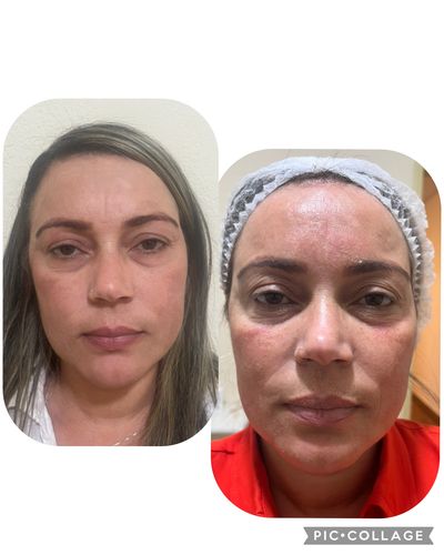 Side-by-side photos of a woman's face showing different skin conditions.