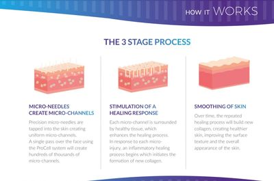 What is Microchanneling