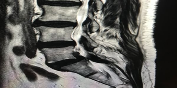 MRI scan of the lower spine and pelvis area.