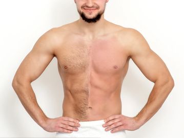 Before & after comparison of man’s chest showing stomach wax, showing smooth skin.