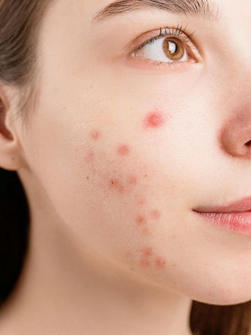 Close-up of woman’s face showing moderate to severe acne on cheeks. 