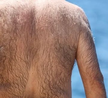 Close-up of man’s hairy back in need of a back wax.