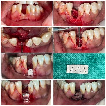 Titanium foil maintains its shape, creating a stable barrier between the flap and the bone defect. 