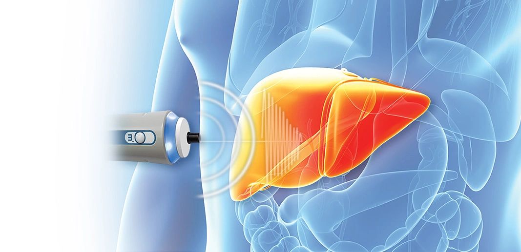 What Is A High Fibroscan Score