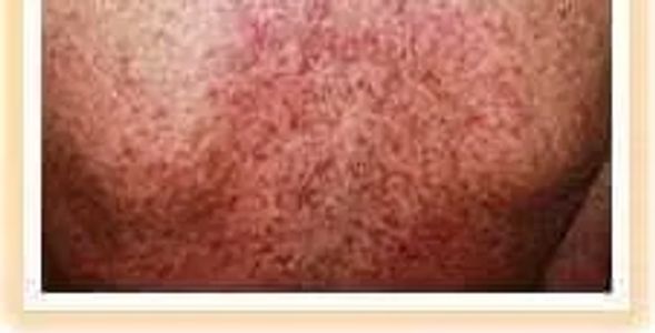 dark spots and rash due to hyperpigmentation