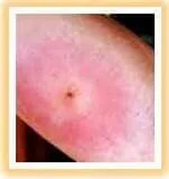 Spider Bite Identification, Symptoms, Treatment