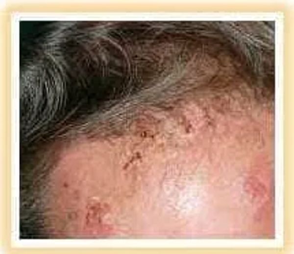 pemphigus on forehead