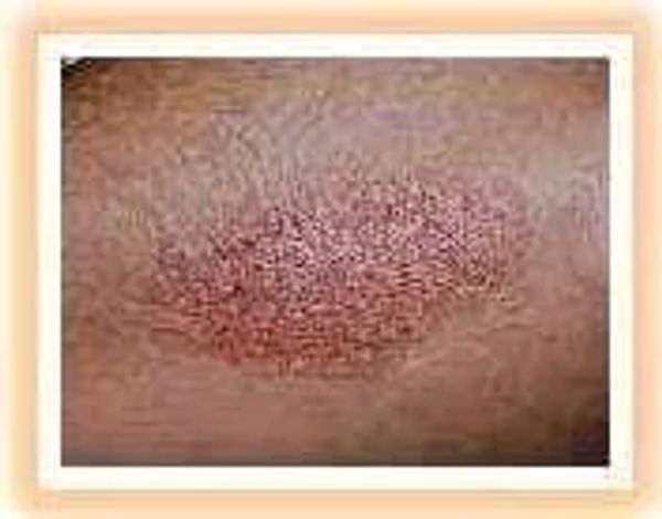 psoriasis on arm