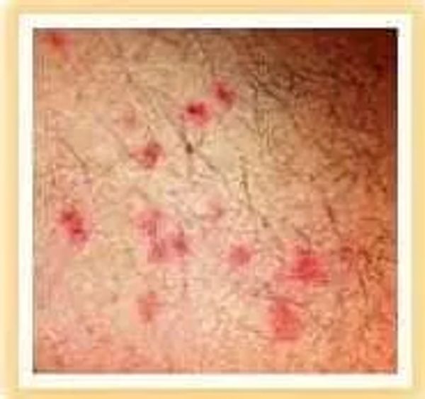 picture of scabies