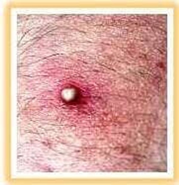 scabies example