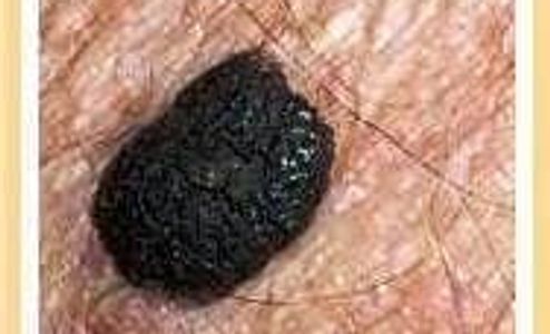 example of possible skin cancer