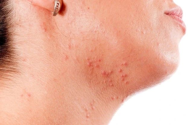 Should You Pop A Pimple?