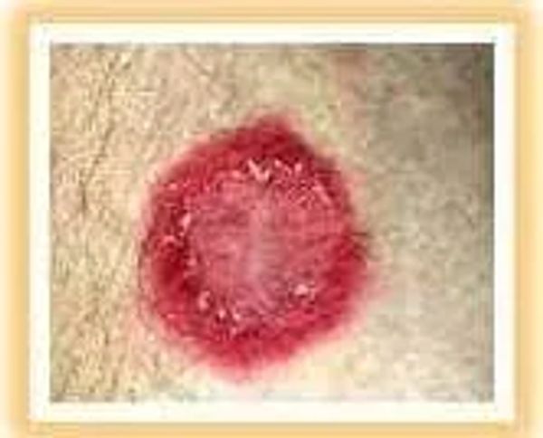 Tinea — Advanced Dermatology