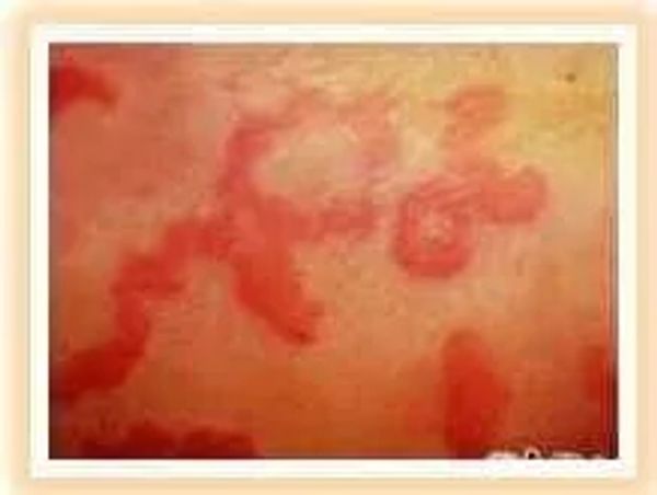 Urticaria Example