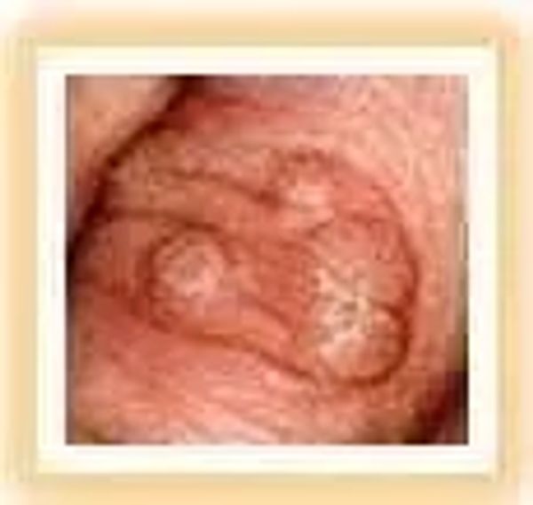 wart picture
