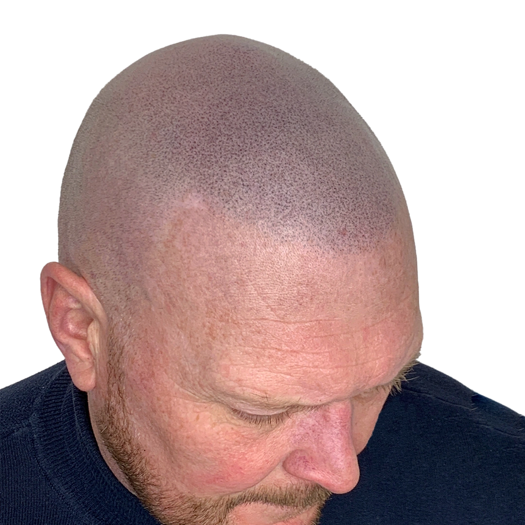 Scalp Micropigmentation Advanced Scalps