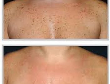 IPL laser pembroke renfrew petawawa laser hair removal botox filler