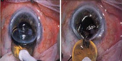 cataract surgery eye extracapsular lens extraction removal capsule intraocular left posterior natural