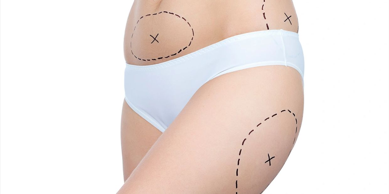 Tratamientos para perder grasa abdominal -Top Clinic