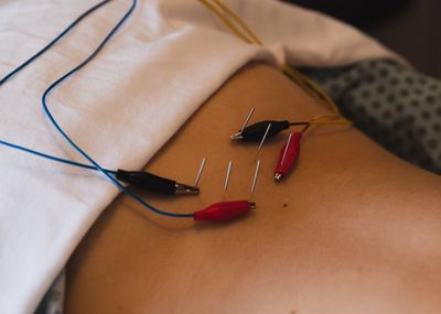 Acupuncture and dry needling for pain in Memphis, TN 