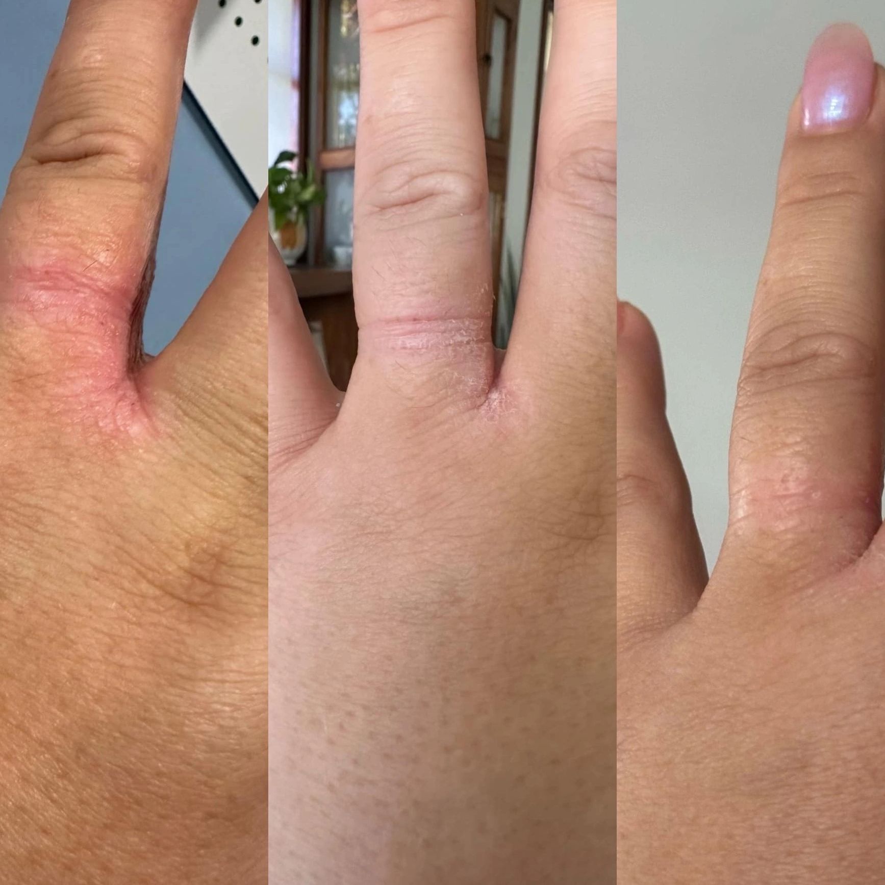 Within 48 hours of using the baby balm or customer had significant reduction to her dermatitis. 