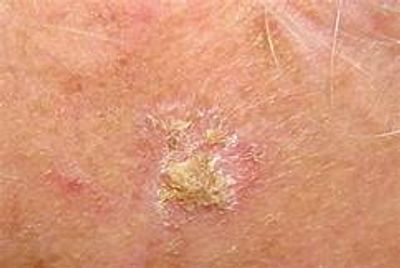 Vincent Polizio, PA-C - Actinic Keratoses, Skin Cancer