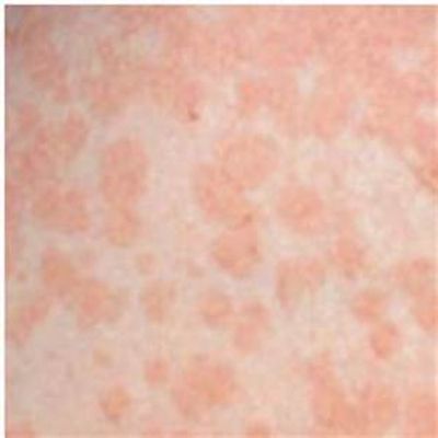 Pityriasis versicolor / Tinea versicolor 