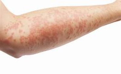 Vincent Polizio, PA-C - Tinea Versicolor, Skin Rash, Fungal Infection