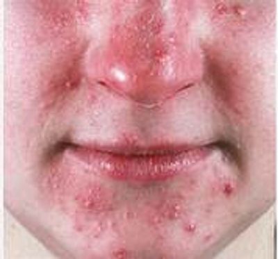 Vincent Polizio, PA-C - Rosacea, Acne Rosacea, Rosacea Treatment