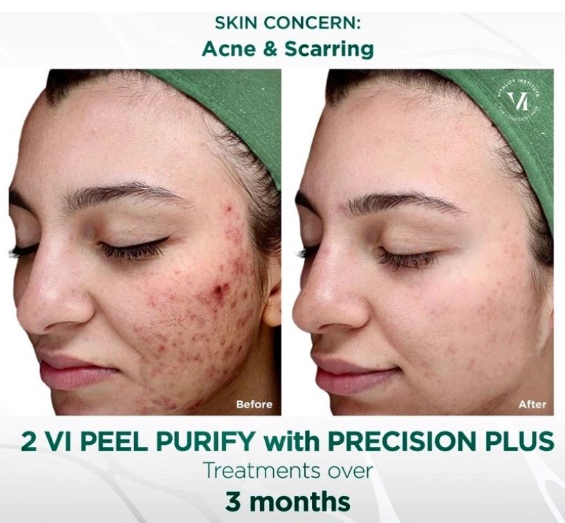 VI Peel Medical Grade Chemical Peel with Medical Dermaplanning 325 Package of 2 599
