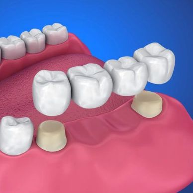 Allon4, Allon6 Dental Implant.
Affordable Dental Treatments