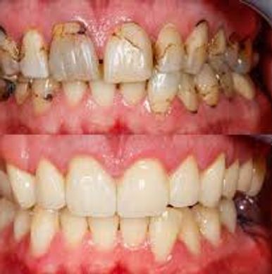 Mouth Rehabilitation, Oral Transformation